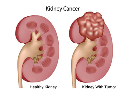 Kidney Tumor Treatment In  Ghatkopar