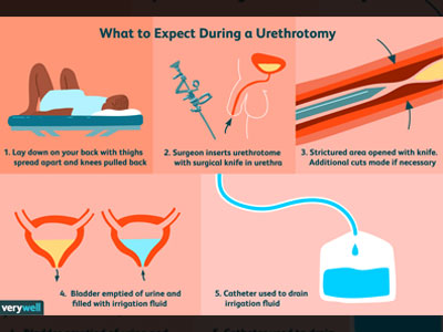 Visualised Internal Urethrotomy Treatment In  Ghatkopar